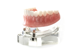 アタッチメント式義歯